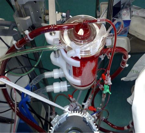 centrifugal ecmo pump|ecmo indication.